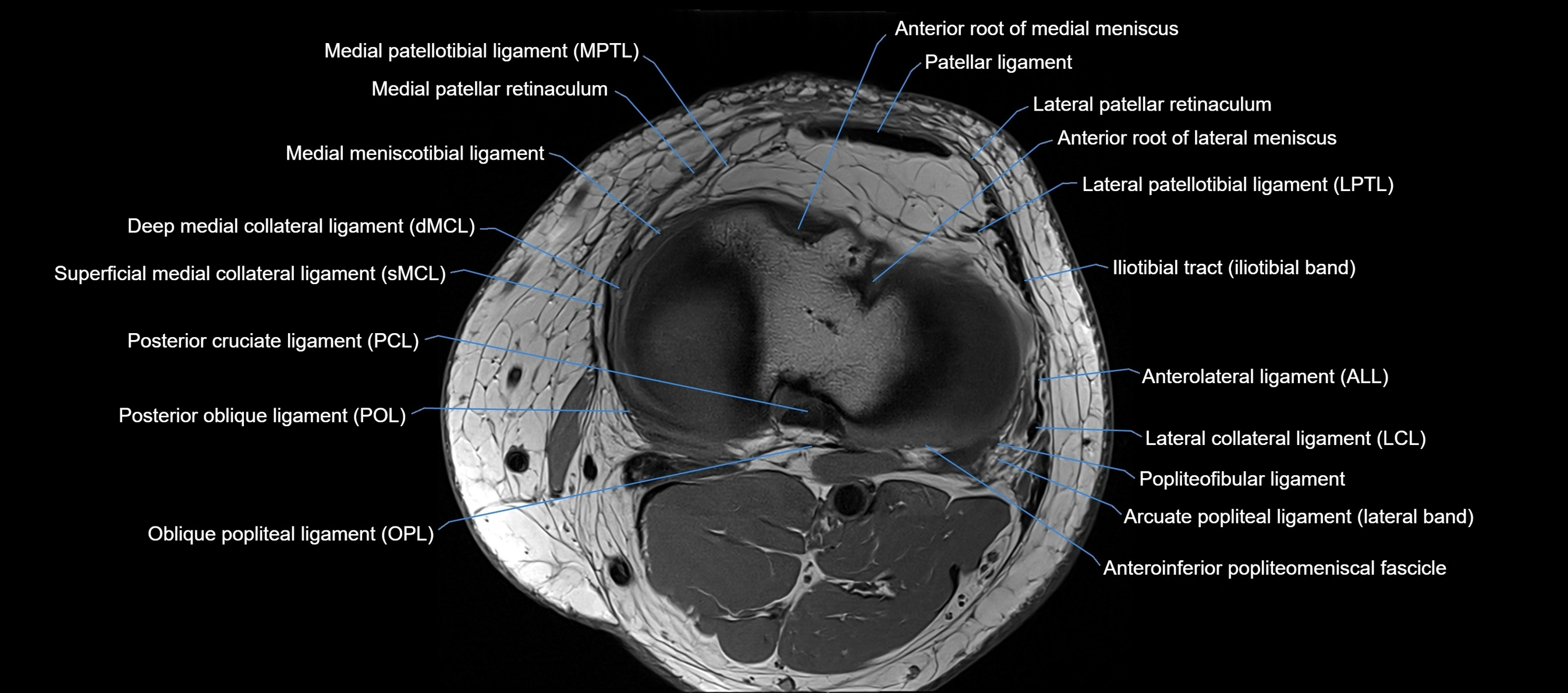 MRI Knee axial  ligaments cross sectional anatomy 3T  radiology  image-img-03001-00031.webp